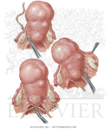 Watermarked preview of unlabeled image: Myomectomy In Treatment of Infertility