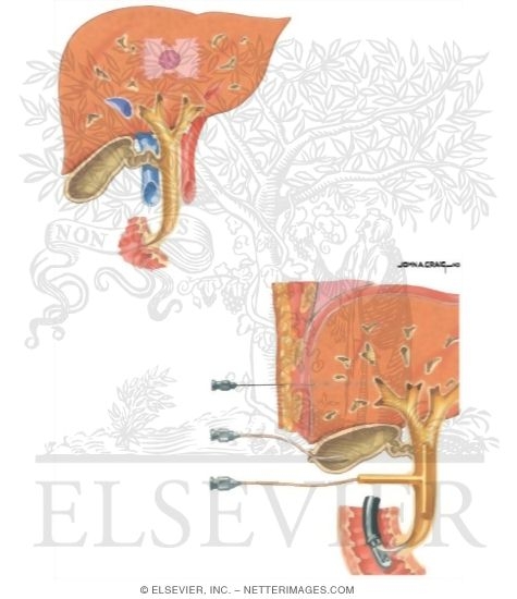 Gallstones: Cholecystography and Cholangiography