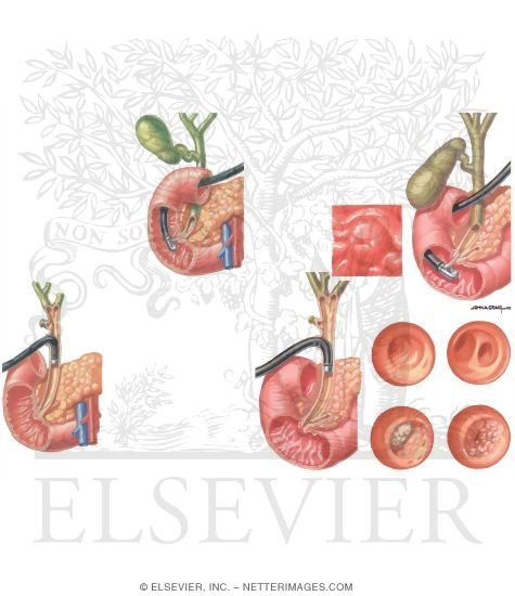 Gallstones: Endoscopic Studies, (Xray Plus Interior of Intestine)