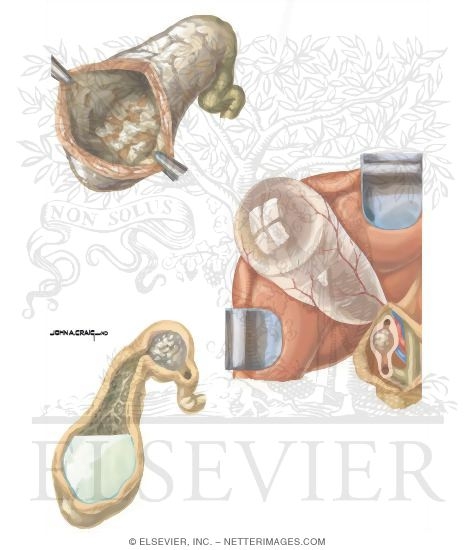 Watermarked preview of unlabeled image: Gallstones: Complications of Calculous Cholecystitis