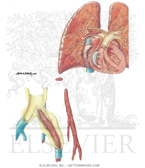 Watermarked preview of unlabeled image: Thrombotic Disorders: Complications of Venous Thrombosis
