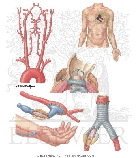 Thrombotic Disorders: Indications for Platelet Inhibitors