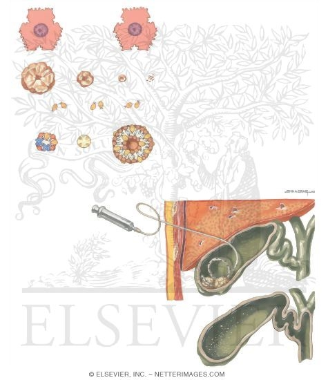 Watermarked preview of unlabeled image: Chemical Dissolution of Gallstones