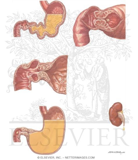Gastric Outlet Obstruction