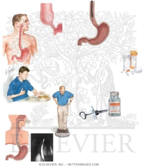 Managing Your Achalasia