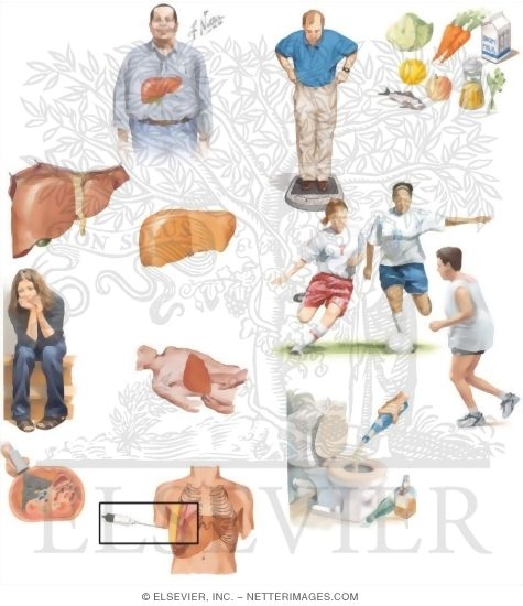 Watermarked preview of unlabeled image: Managing Your Fatty Liver