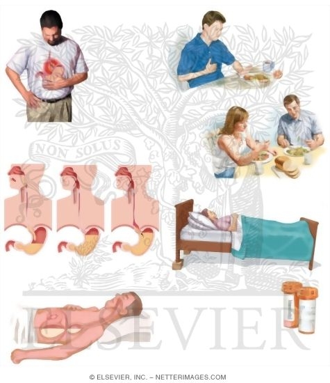 Watermarked preview of unlabeled image: Managing Your Gastroesophageal Reflux Disease (GERD)