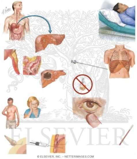 Watermarked preview of unlabeled image: Managing Your Liver Abscess