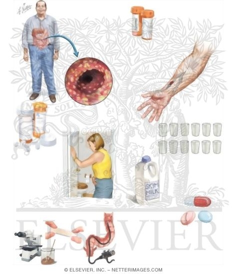 Watermarked preview of unlabeled image: Managing Your Pseudomembranous Colitis