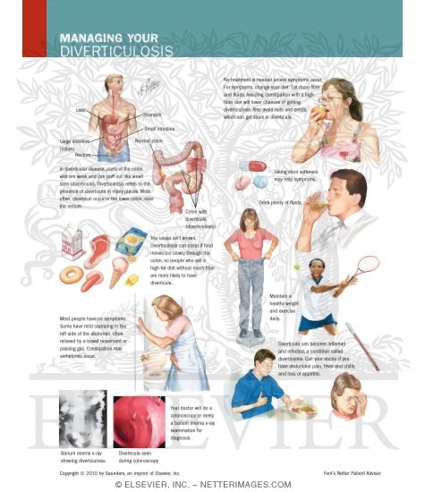 Watermarked preview of labeled image: Managing Your Diverticulosis