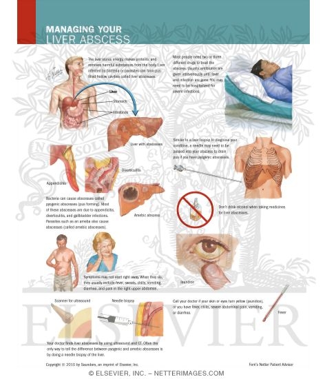 Managing Your Liver Abscess