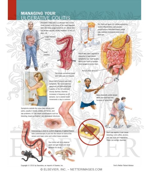 Watermarked preview of labeled image: Managing Your Ulcerative Colitis