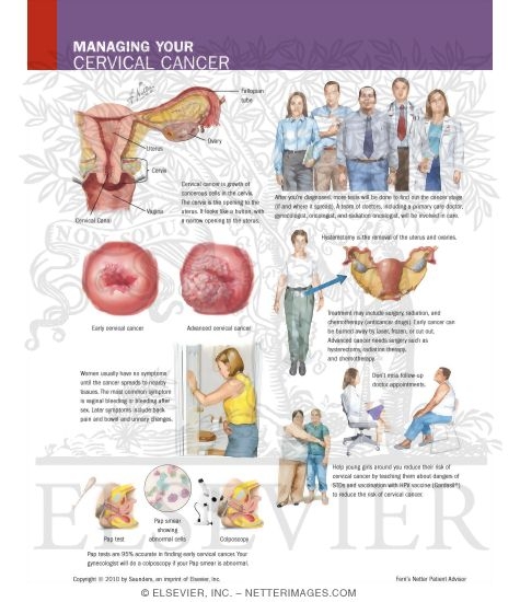 Watermarked preview of labeled image: Managing Your Cervical Cancer