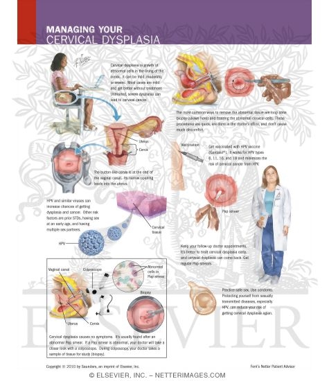 Watermarked preview of labeled image: Managing Your Cervical Dysplasia