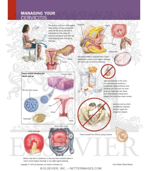 Watermarked preview of labeled image: Managing Your Cervicitis