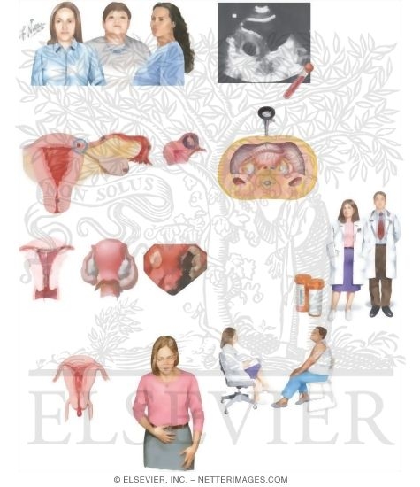 Watermarked preview of unlabeled image: Managing Your Ectopic Pregnancy
