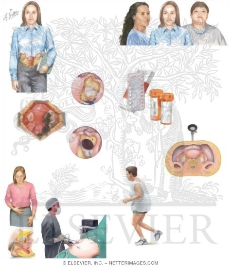Watermarked preview of unlabeled image: Managing Your Endometriosis