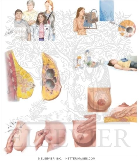 Watermarked preview of unlabeled image: Managing Your Fibrocystic Breast Changes