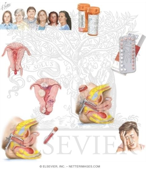 Watermarked preview of unlabeled image: Managing Your Dysfunctional Uterine Bleeding