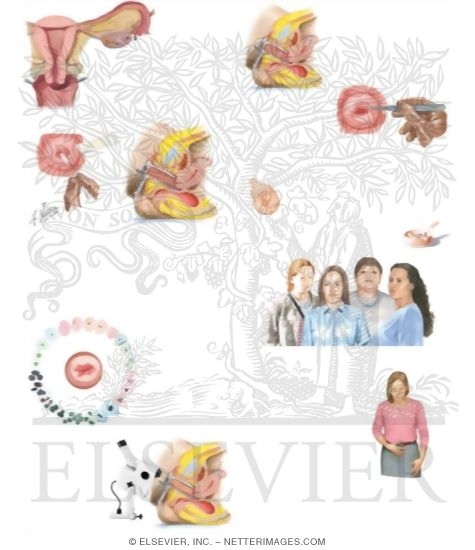Watermarked preview of unlabeled image: Understanding Your Pap Smear Abnormalities