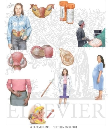 Managing Your Pelvic Inflammatory Disease