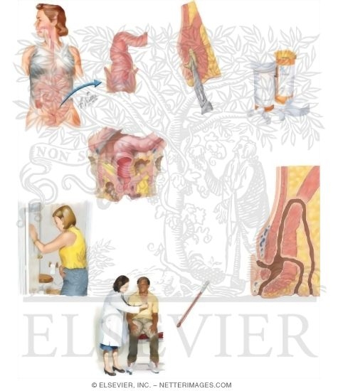 Watermarked preview of unlabeled image: Managing Your Perirectal Abscess