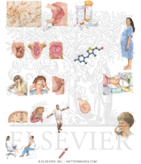 Watermarked preview of unlabeled image: Managing Your Syphilis