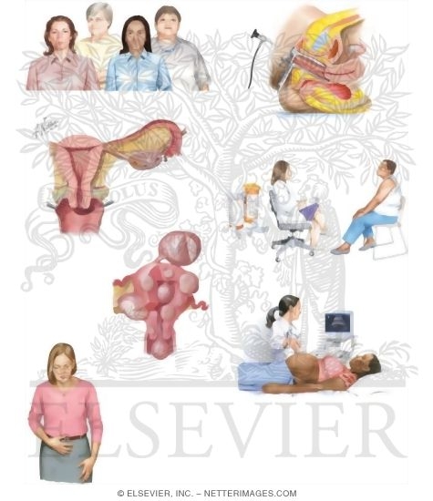 Watermarked preview of unlabeled image: Managing Your Uterine Fibroids