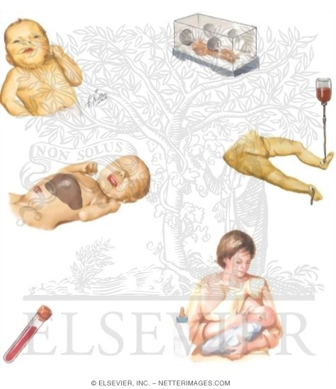 Watermarked preview of unlabeled image: Caring for Your Newborn With Jaundice