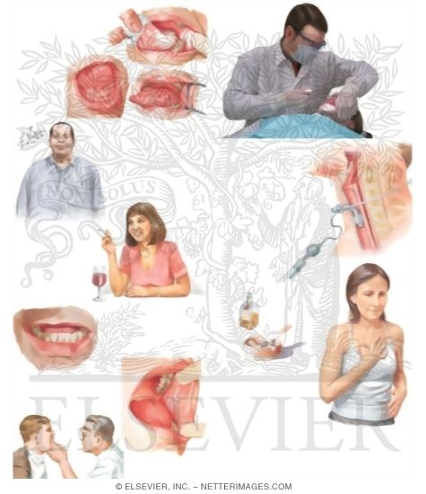 Watermarked preview of unlabeled image: Managing Your Mouth Cancer