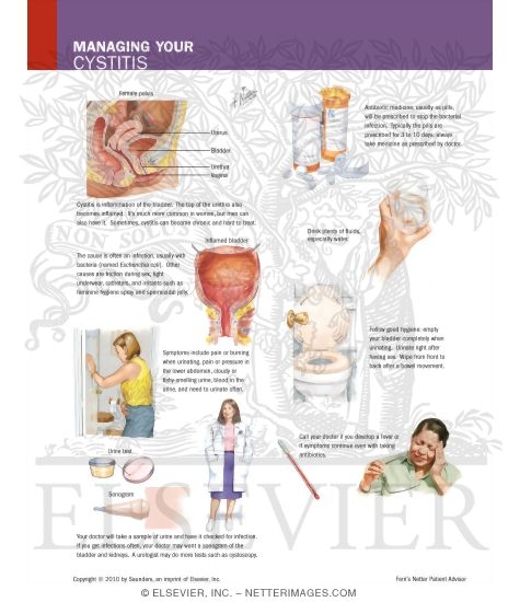 Watermarked preview of labeled image: Managing Your Cystitis