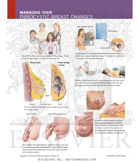 Watermarked preview of labeled image: Managing Your Fibrocystic Breast Changes