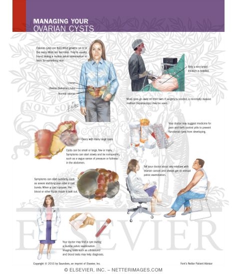 Watermarked preview of labeled image: Managing Your Ovarian Cysts