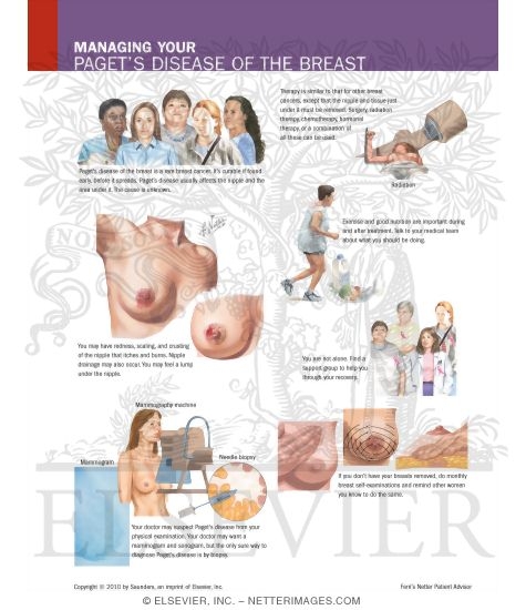 Watermarked preview of labeled image: Managing Your Paget's Disease of the Breast