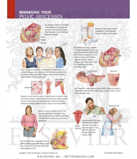 Watermarked preview of labeled image: Managing Your Pelvic Abscesses