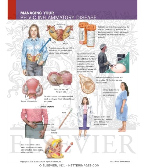 Watermarked preview of labeled image: Managing Your Pelvic Inflammatory Disease