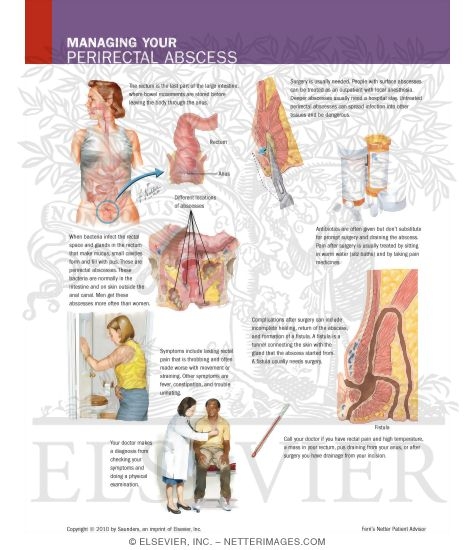 Watermarked preview of labeled image: Managing Your Perirectal Abscess