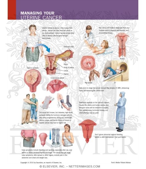 Watermarked preview of labeled image: Managing Your Uterine Cancer