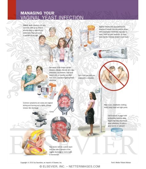 Watermarked preview of labeled image: Managing Your Vaginal Yeast Infection