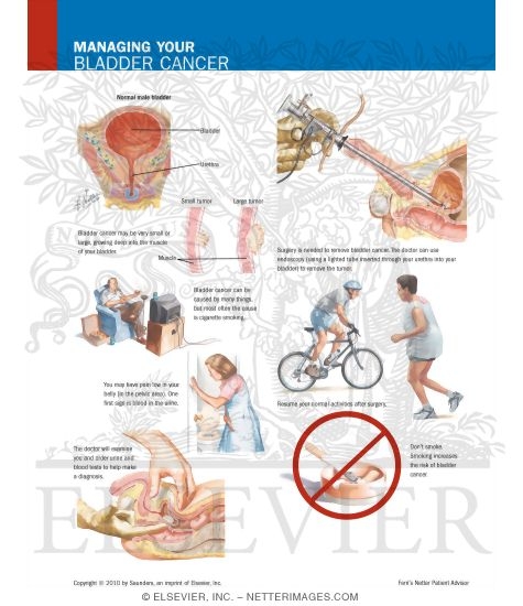 Watermarked preview of labeled image: Managing Your Bladder Cancer