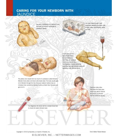 Caring for Your Newborn With Jaundice