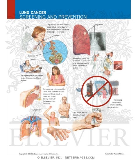 Watermarked preview of labeled image: Lung Cancer Screening and Prevention