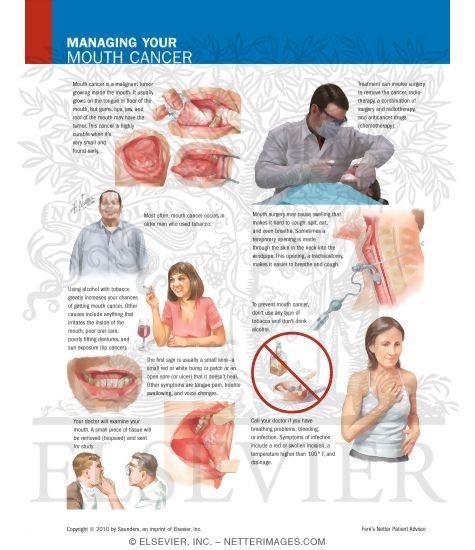 Watermarked preview of labeled image: Managing Your Mouth Cancer