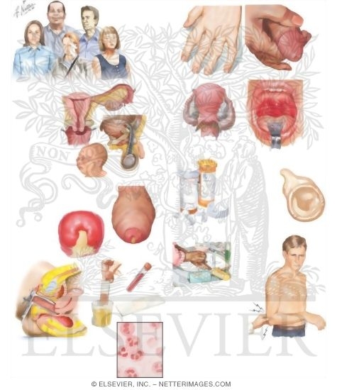 Watermarked preview of unlabeled image: Managing Your Gonorrhea
