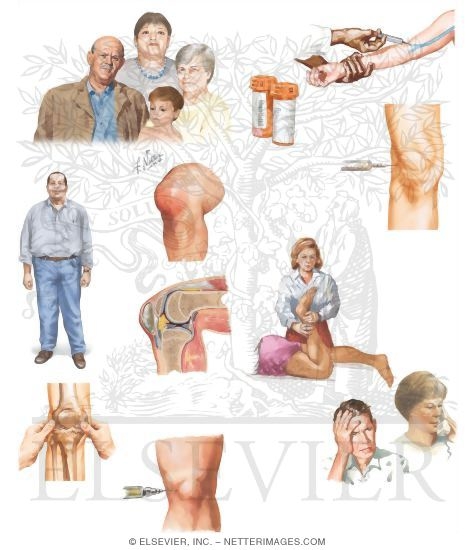 Watermarked preview of unlabeled image: Managing Your Septic Arthritis