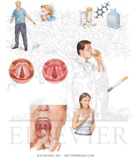 Watermarked preview of unlabeled image: Managing Your Laryngitis