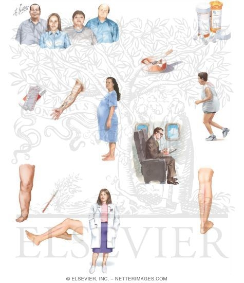 Watermarked preview of unlabeled image: Managing Your Thrombophlebitis