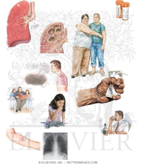 Managing Your Tuberculosis