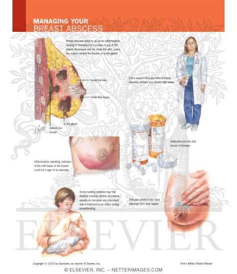 Watermarked preview of labeled image: Managing Your Breast Abscess