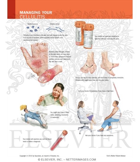 Managing Your Cellulitis